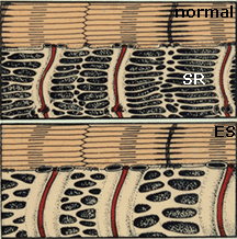 Cartoon depicting swelling of the SR