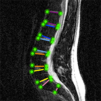 Digitization of vertebral bodies in the lumbar spine