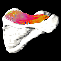 Reconstructed MRI image demonstrating muscle tractography