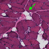 Image of fat infiltration into skeletal muscle
